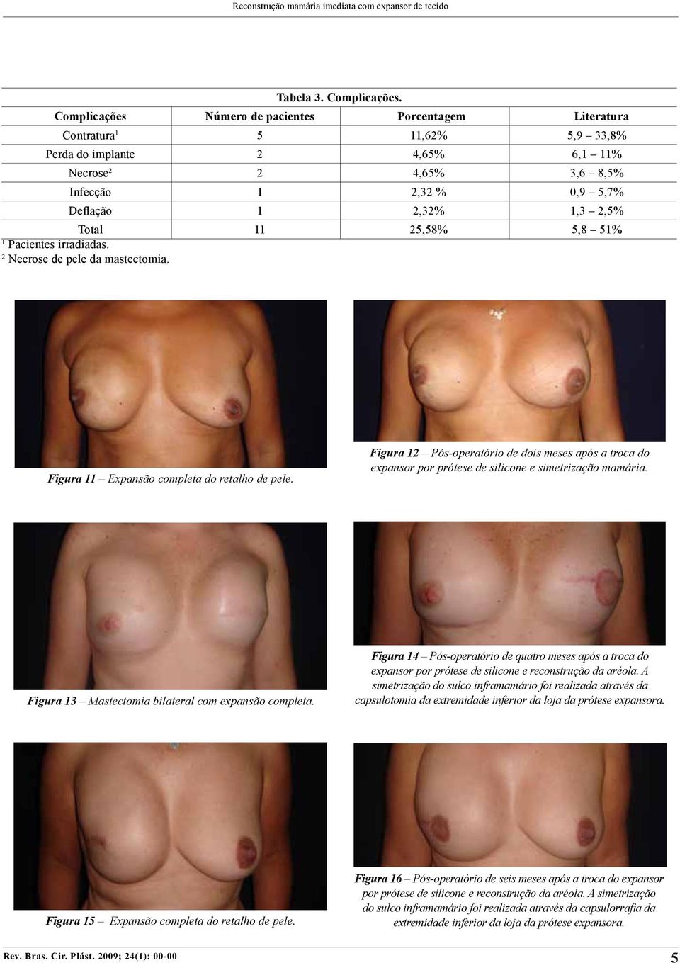 2,5% Total 11 25,58% 5,8 51% 1 Pacientes irradiadas. 2 Necrose de pele da mastectomia. Figura 11 Expansão completa do retalho de pele.