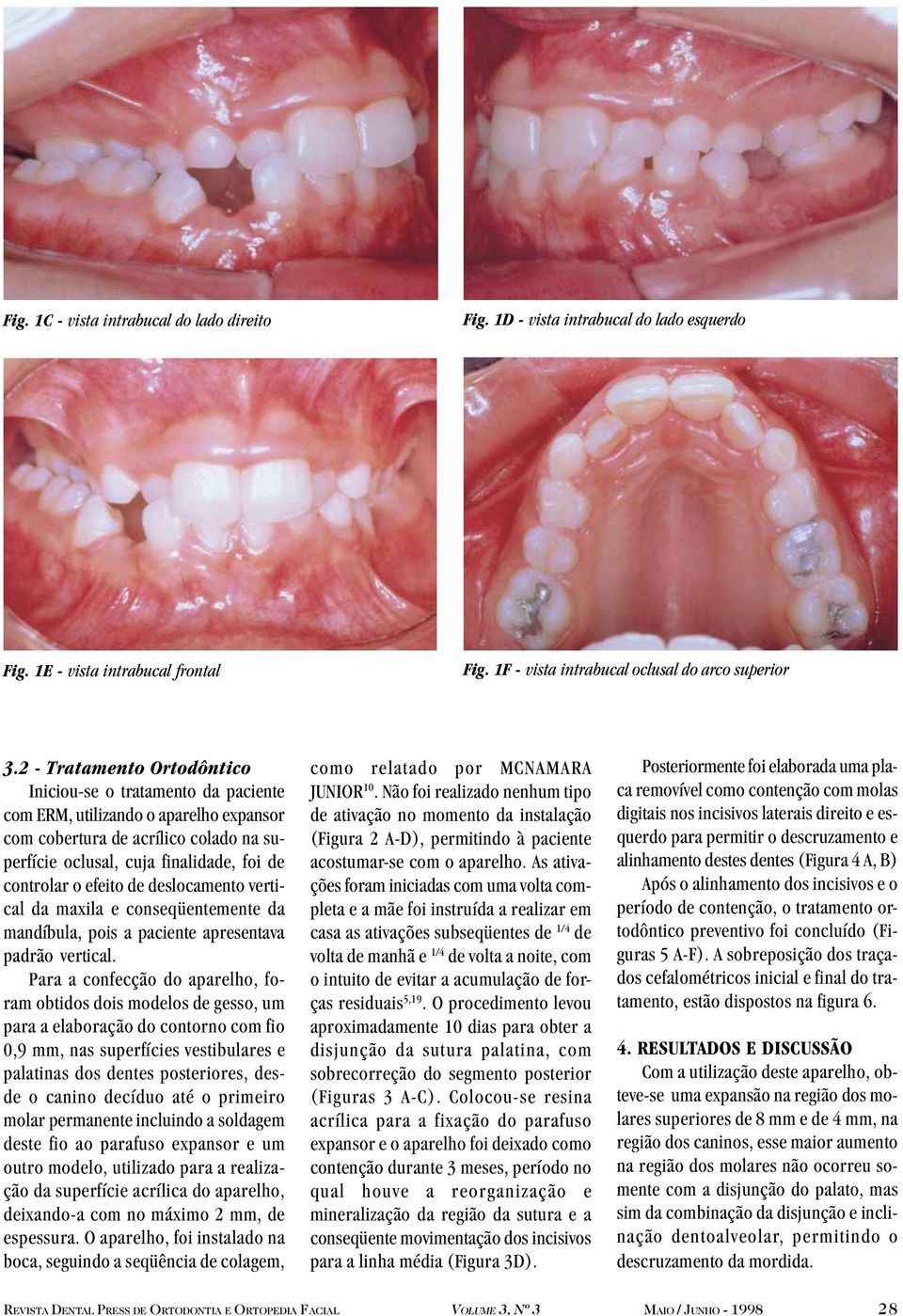efeito de deslocamento vertical da maxila e conseqüentemente da mandíbula, pois a paciente apresentava padrão vertical.