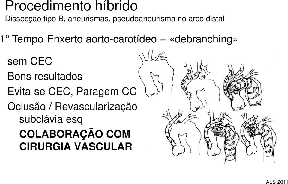 CEC Bons resultados Evita-se CEC, Paragem CC Oclusão /