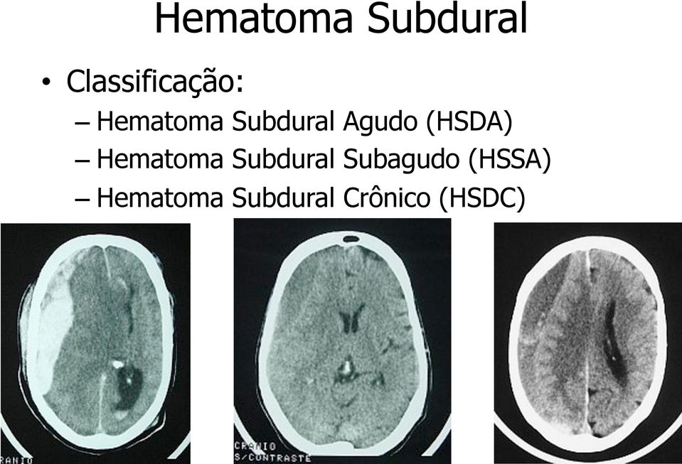 Hematoma Subdural Subagudo