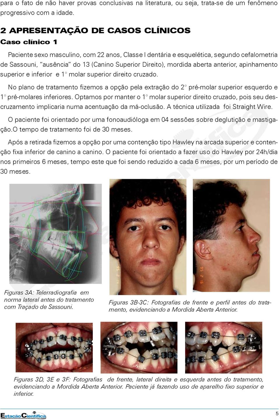 mordida aberta anterior, apinhamento superior e inferior e 1 molar superior direito cruzado.