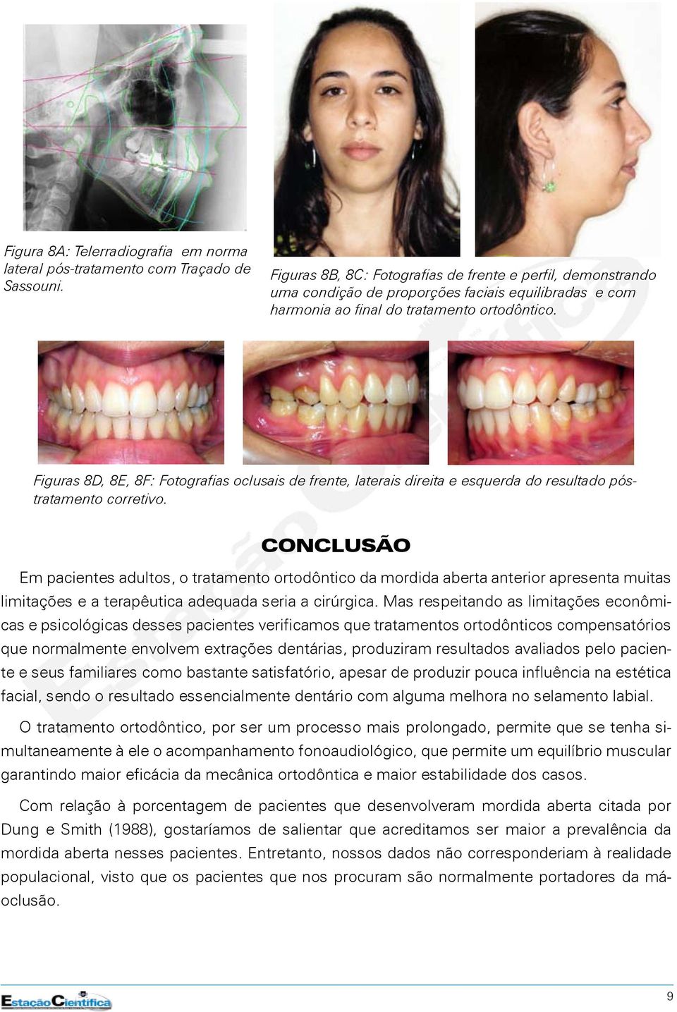 Figuras 8D, 8E, 8F: Fotografias oclusais de frente, laterais direita e esquerda do resultado póstratamento corretivo.