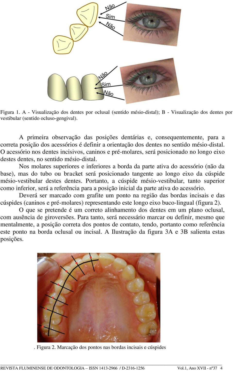 O acessório nos dentes incisivos, caninos e pré-molares, será posicionado no longo eixo destes dentes, no sentido mésio-distal.