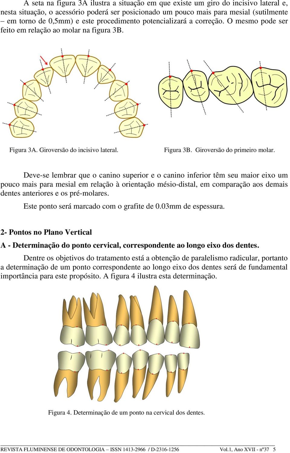 Deve-se lembrar que o canino superior e o canino inferior têm seu maior eixo um pouco mais para mesial em relação à orientação mésio-distal, em comparação aos demais dentes anteriores e os