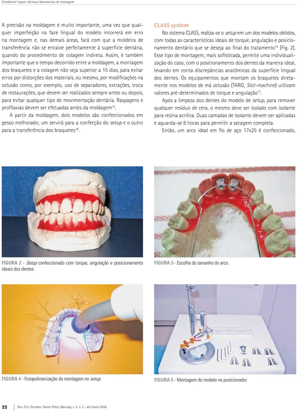 Assim, é também importante que o tempo decorrido entre a moldagem, a montagem dos braquetes e a colagem não seja superior a 15 dias, para evitar erros por distorções dos materiais, ou mesmo, por