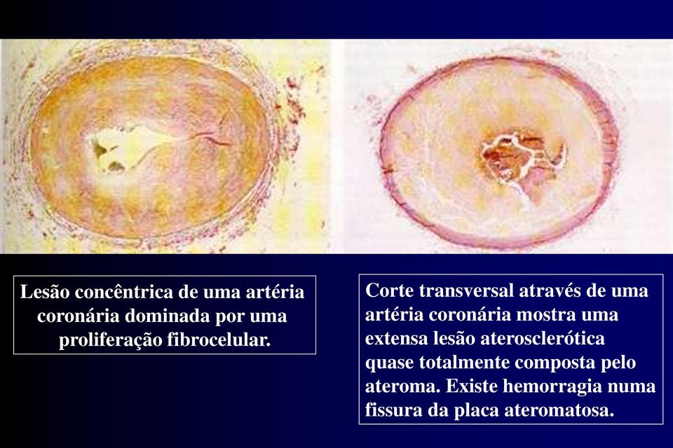 Corte transversal através de uma artéria coronária mostra uma