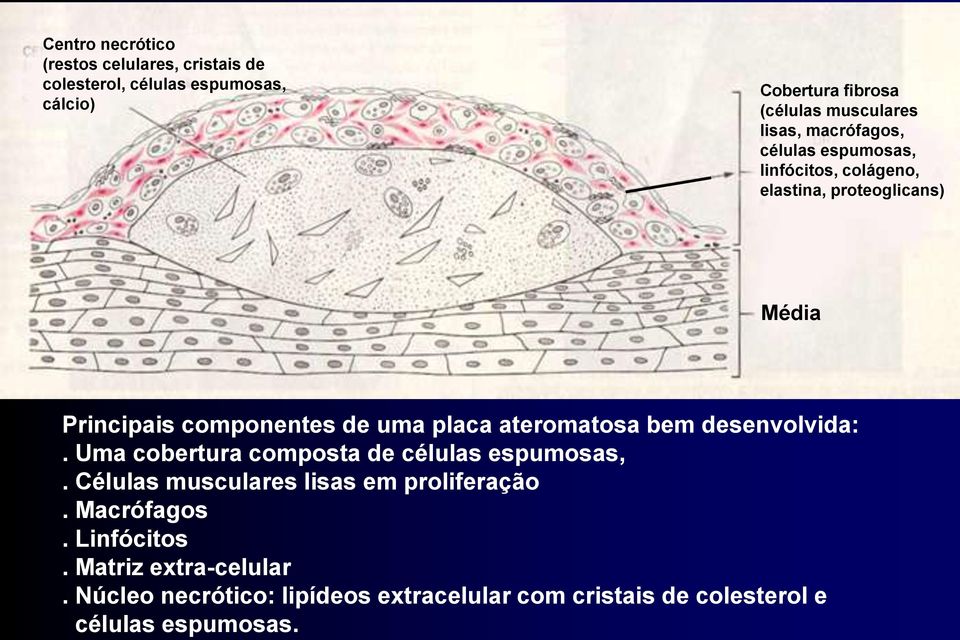 Núcleo necrótico: lipídeos extracelular com cristais de colesterol e células espumosas.