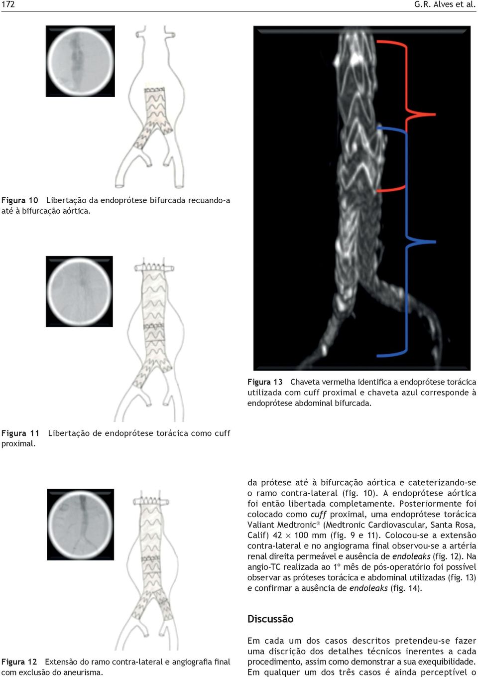 Figura 11 Libertação de endoprótese torácica como cuff proximal. da prótese até à bifurcação aórtica e cateterizando-se o ramo contra-lateral (fig. 10).