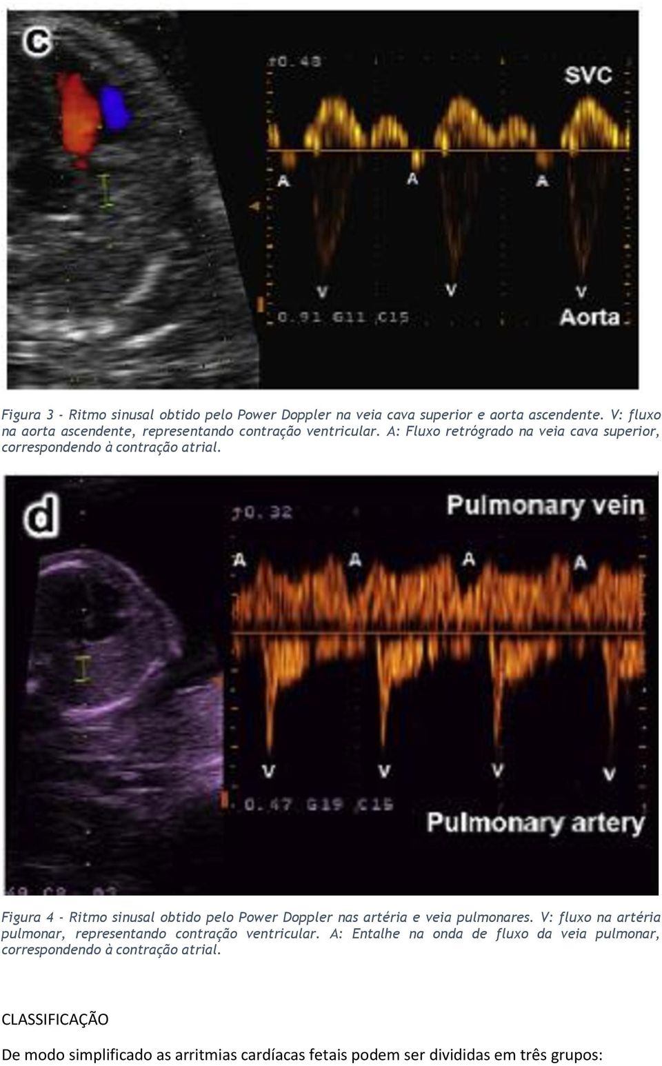 A: Fluxo retrógrado na veia cava superior, correspondendo à contração atrial.