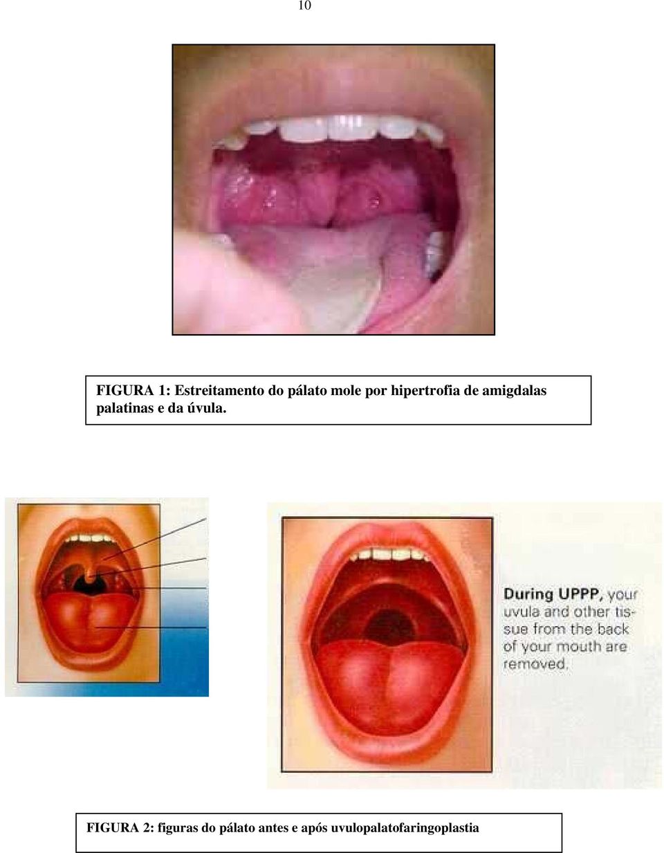 palatinas e da úvula.
