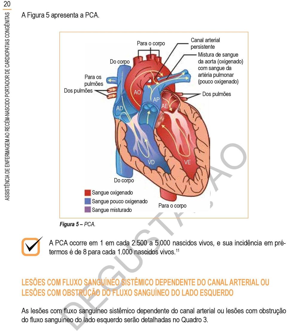 oxigenado) A PCA ocorre em 1 em cada 2.500 a 5.000 nascidos vivos,