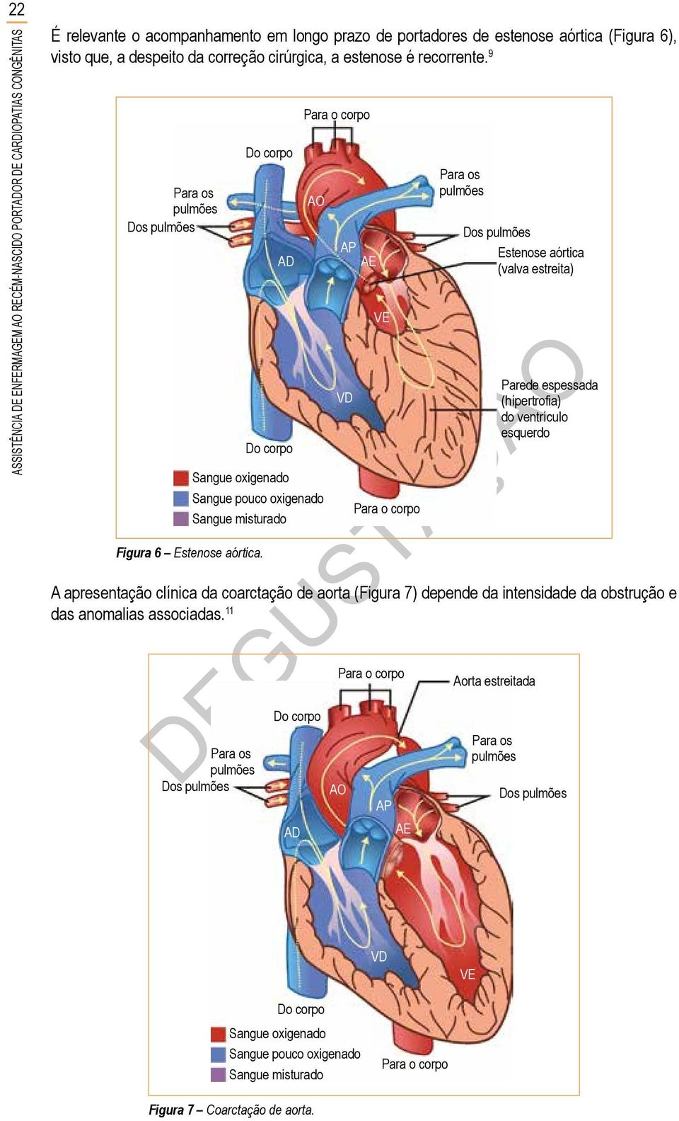 AP AE VD VE Estenose aórtica (valva estreita) Parede espessada (hípertrofia) do ventrículo esquerdo A apresentação clínica da coarctação de aorta (Figura 7) depende da