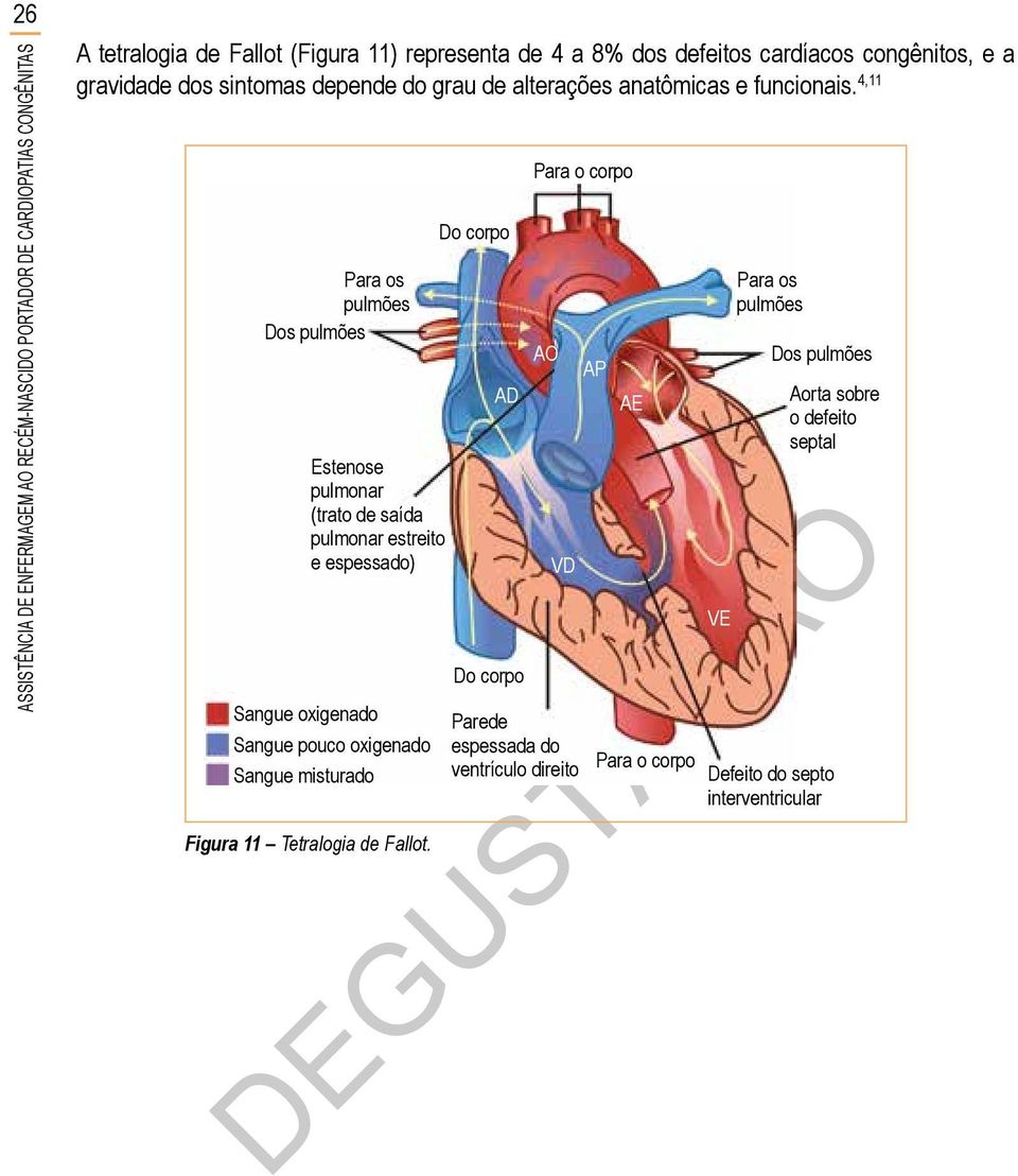 4,11 Estenose pulmonar (trato de saída pulmonar estreito e espessado) Sangue oxigenado Sangue pouco oxigenado Sangue misturado Figura