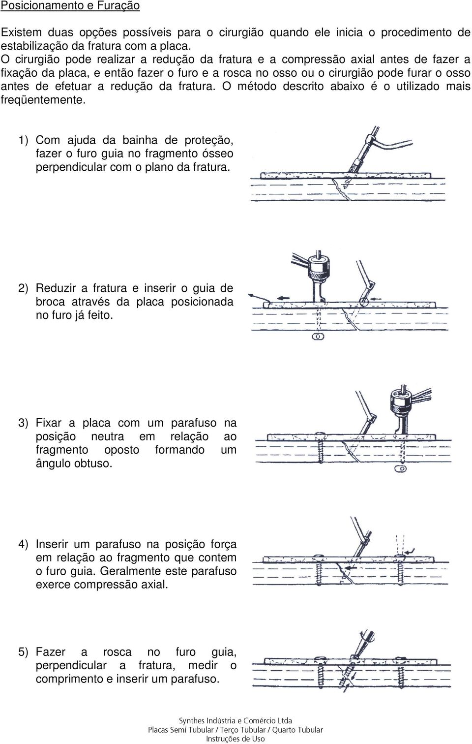 redução da fratura. O método descrito abaixo é o utilizado mais freqüentemente. 1) Com ajuda da bainha de proteção, fazer o furo guia no fragmento ósseo perpendicular com o plano da fratura.