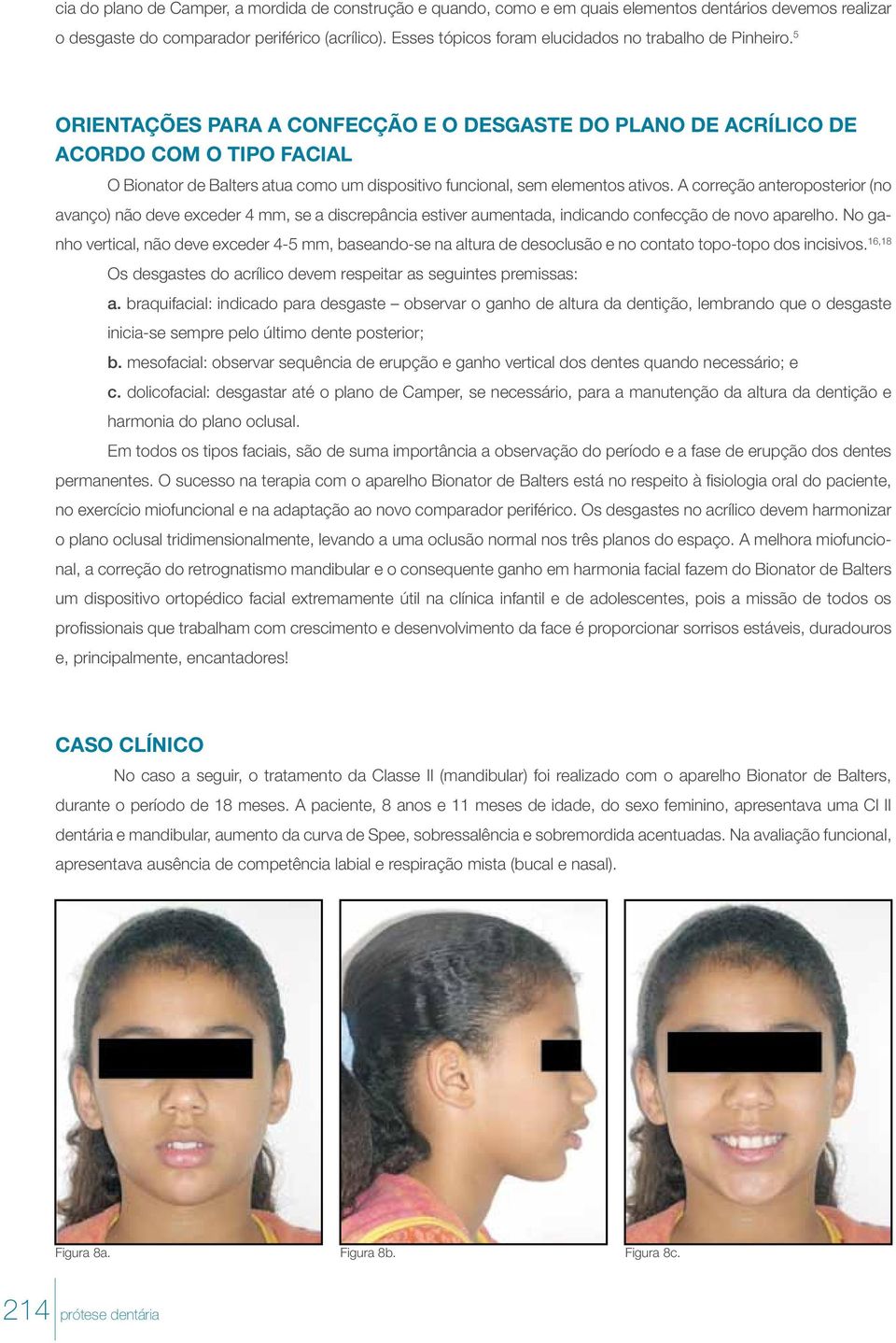 5 Orientações para a confecção e o desgaste do plano de acrílico de acordo com o tipo facial O Bionator de Balters atua como um dispositivo funcional, sem elementos ativos.