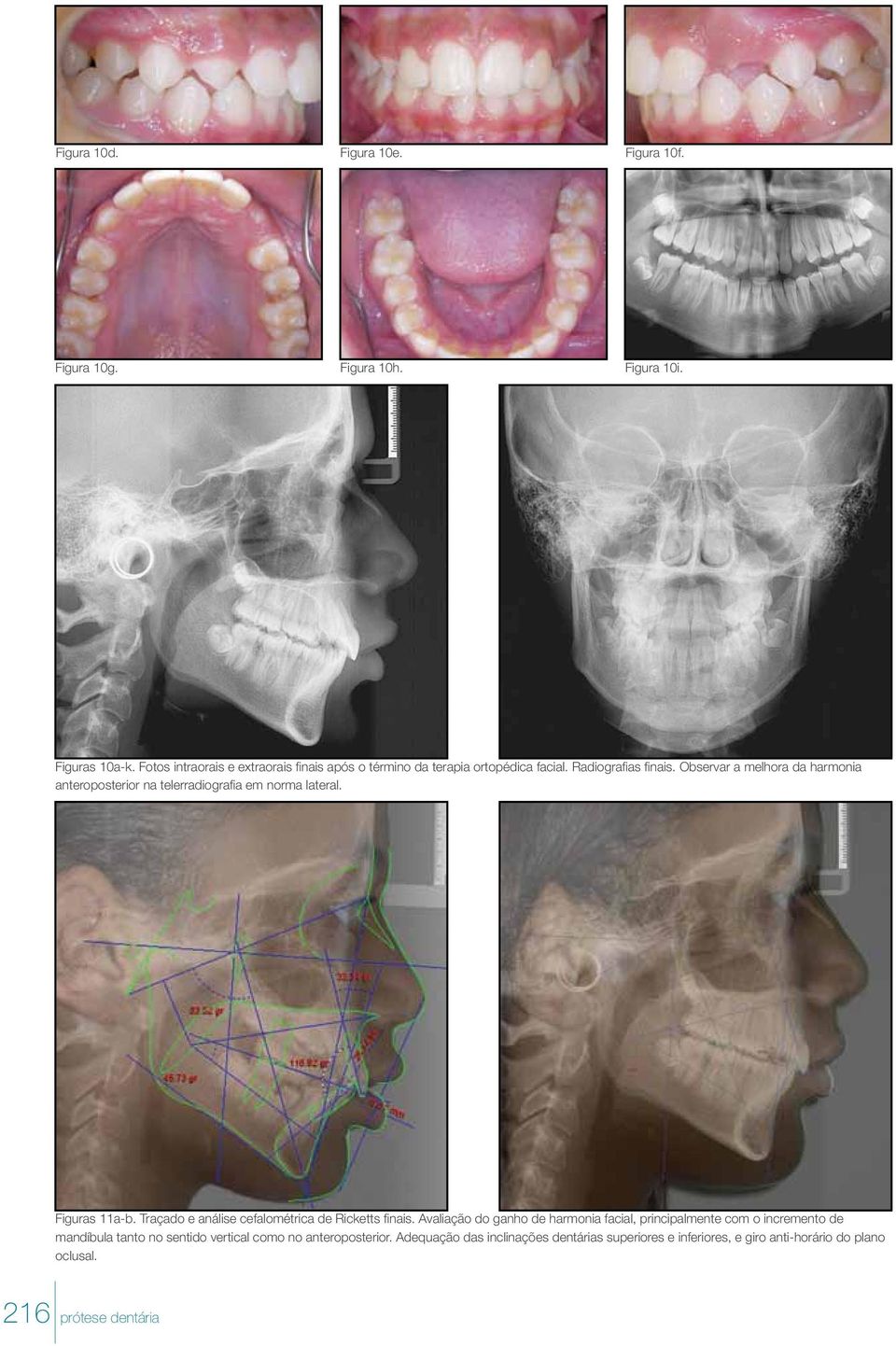 Observar a melhora da harmonia anteroposterior na telerradiografia em norma lateral. Figuras 11a-b.