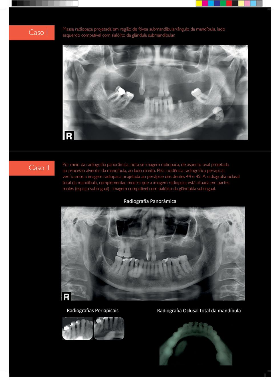 Pela incidência radiográfica periapical, verificamos a imagem radiopaca projetada ao periápice dos dentes 44 e 45.