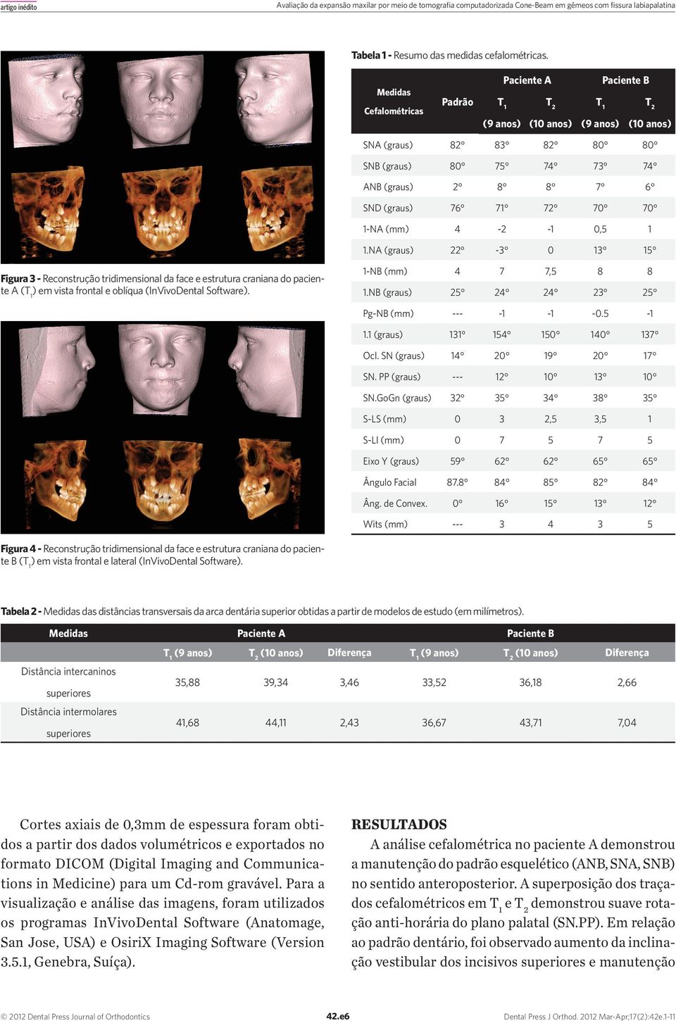 (mm) 4-2 -1 0,5 1 1.NA (graus) 22-3 0 13 15 Figura 3 - Reconstrução tridimensional da face e estrutura craniana do paciente A ( ) em vista frontal e oblíqua (InVivoDental Software).