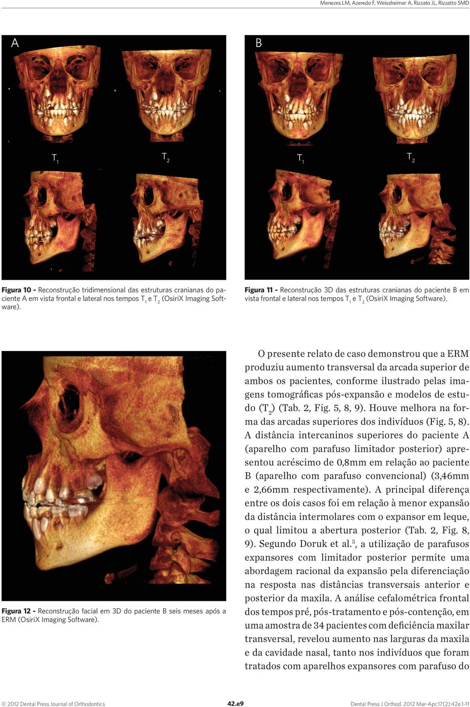 Figura 12 - Reconstrução facial em 3D do paciente B seis meses após a ERM (OsiriX Imaging Software).