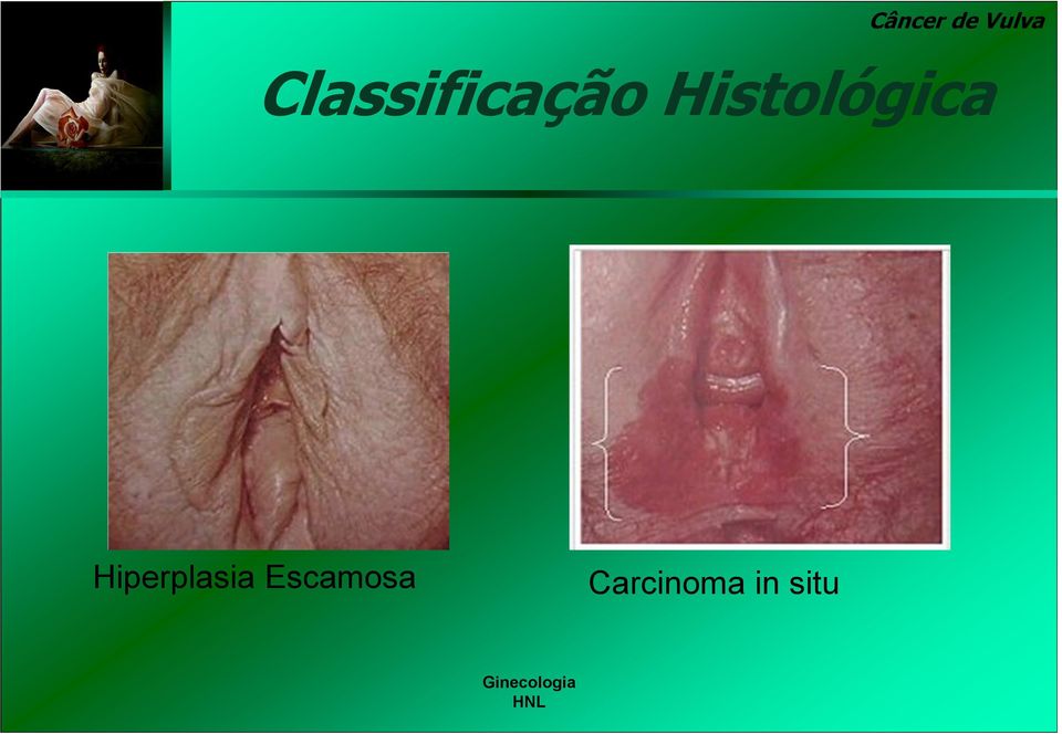 Histológica Hiperplasia