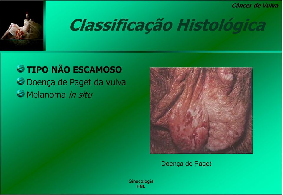 Doença de Paget da vulva Melanoma