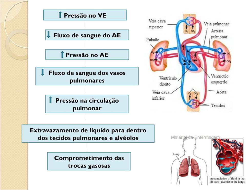 pulmonar Extravazamento de líquido para dentro dos