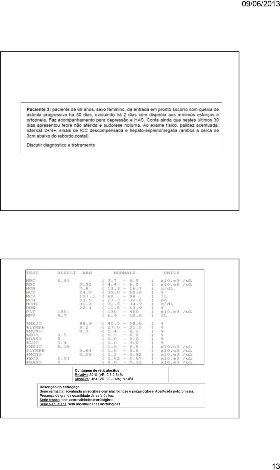 poiquilocitose. Acentuada policromasia. Presença de grande quantidade de esferócitos.