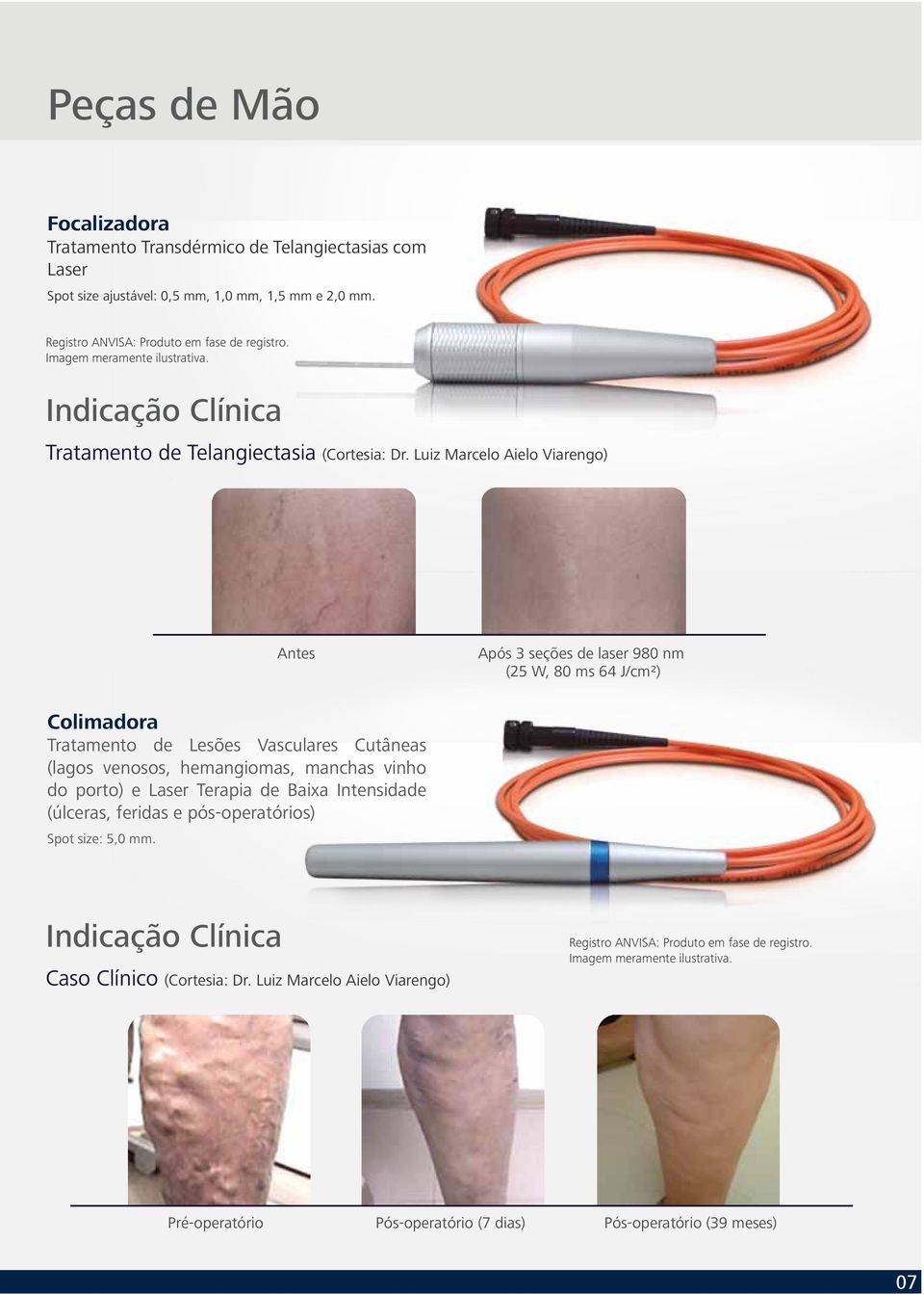 Luiz Marcelo Aielo Viarengo) Antes Após 3 seções de laser 980 nm (25 W, 80 ms 64 J/cm²) Colimadora Tratamento de Lesões Vasculares Cutâneas (lagos venosos, hemangiomas, manchas