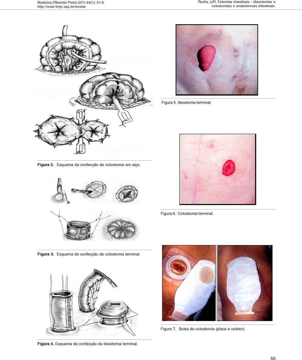 Colostomia terminal. Figura 3. Esquema da confecção da colostomia terminal.