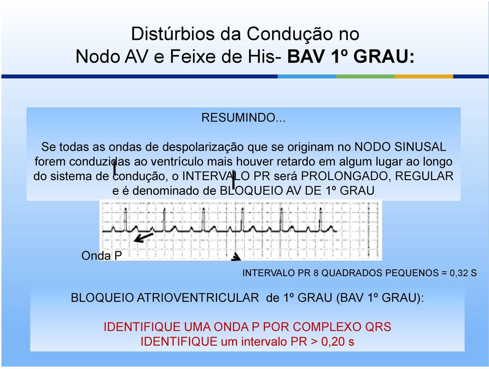 algum lugar ao longo do sistema de condução, o INTERVALO PR será PROLONGADO, REGULAR e é denominado de BLOQUEIO AV DE 1º GRAU