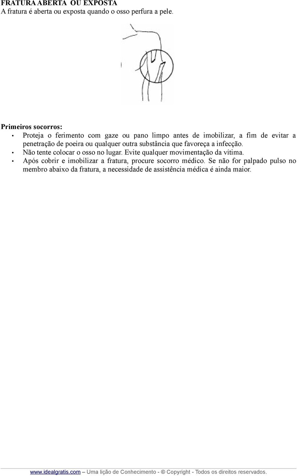 qualquer outra substância que favoreça a infecção. Não tente colocar o osso no lugar. Evite qualquer movimentação da vítima.