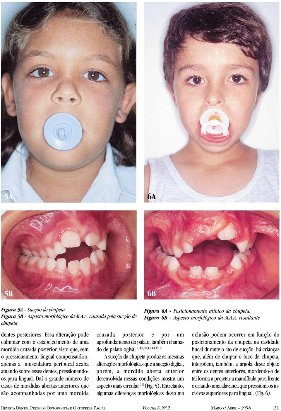 Essa alteração pode culminar com o estabelecimento de uma mordida cruzada posterior, visto que, sem o pressionamento lingual compensatório, apenas a musculatura peribucal acaba atuando sobre esses