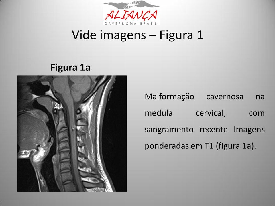 cervical, com sangramento recente