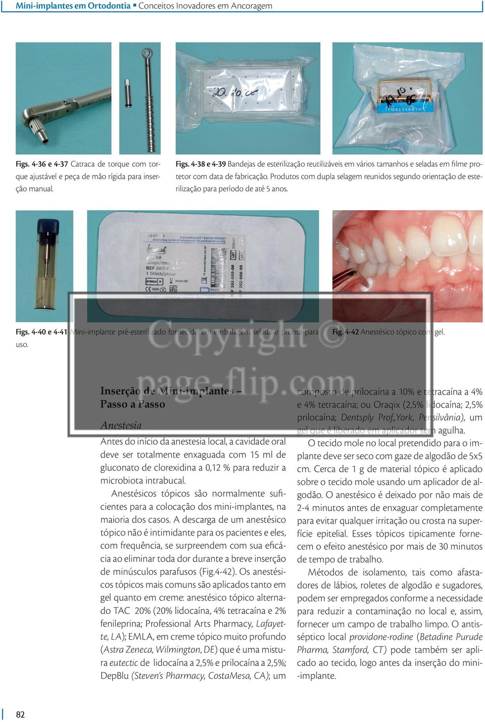 Inserção de Mini-implantes Passo a Passo Anestesia Antes do início da anestesia local, a cavidade oral deve ser totalmente enxaguada com 15 ml de gluconato de clorexidina a 0,12 % para reduzir a