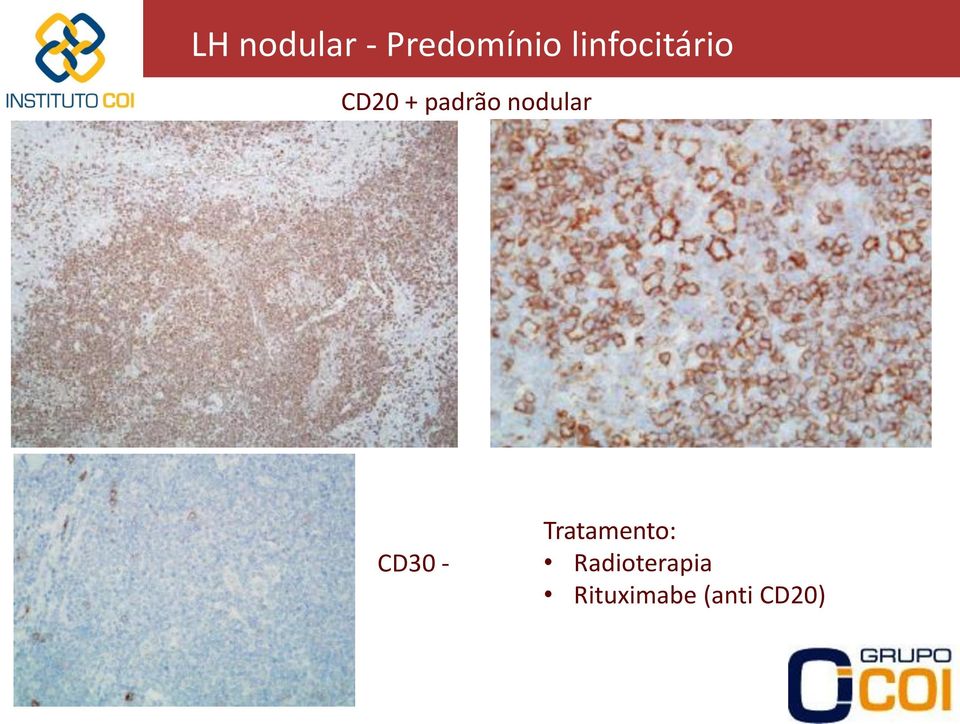 nodular CD30 - Tratamento: