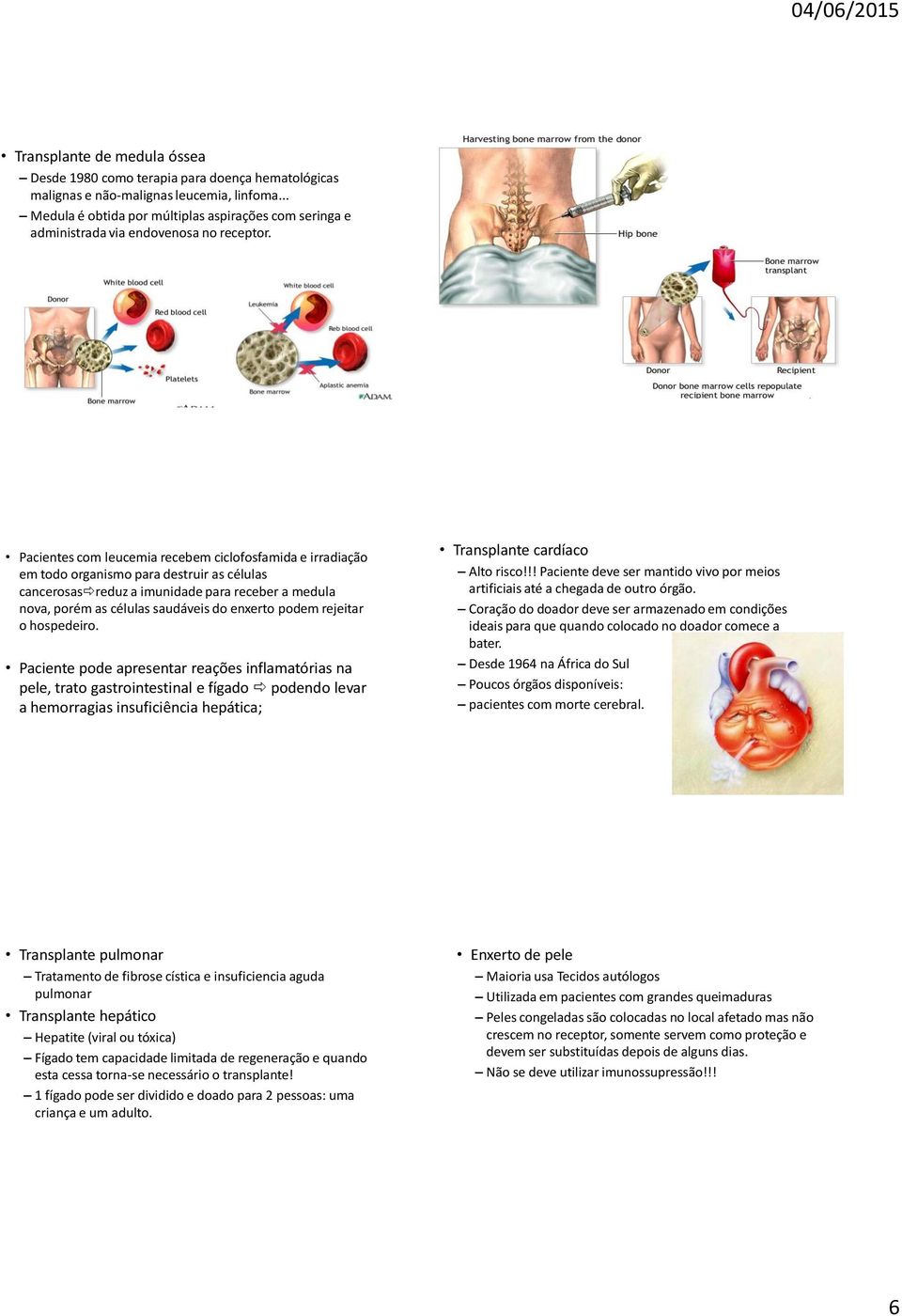 Pacientes com leucemia recebem ciclofosfamida e irradiação em todo organismo para destruir as células cancerosas reduz a imunidade para receber a medula nova, porém as células saudáveis do enxerto