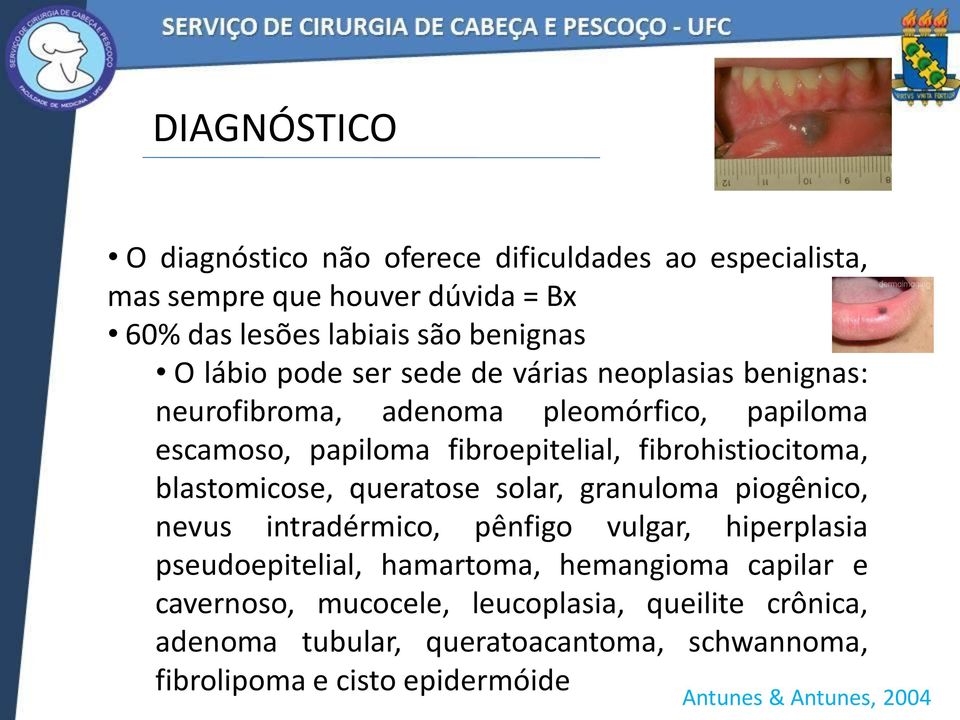 blastomicose, queratose solar, granuloma piogênico, nevus intradérmico, pênfigo vulgar, hiperplasia pseudoepitelial, hamartoma, hemangioma capilar