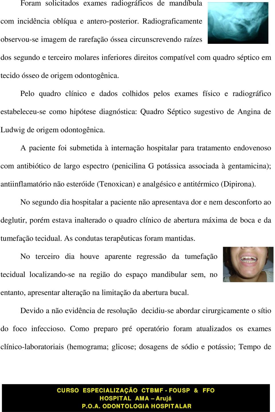 Pelo quadro clínico e dados colhidos pelos exames físico e radiográfico estabeleceu-se como hipótese diagnóstica: Quadro Séptico sugestivo de Angina de Ludwig de origem odontogênica.