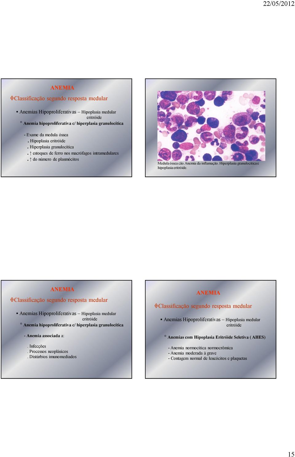 Anemias Hipoproliferativas Hipoplasia medular eritróide Anemia hipoproliferativa c/ hiperplasia granulocítica - Anemia associada a:. Infecções. Processos neoplásicos.