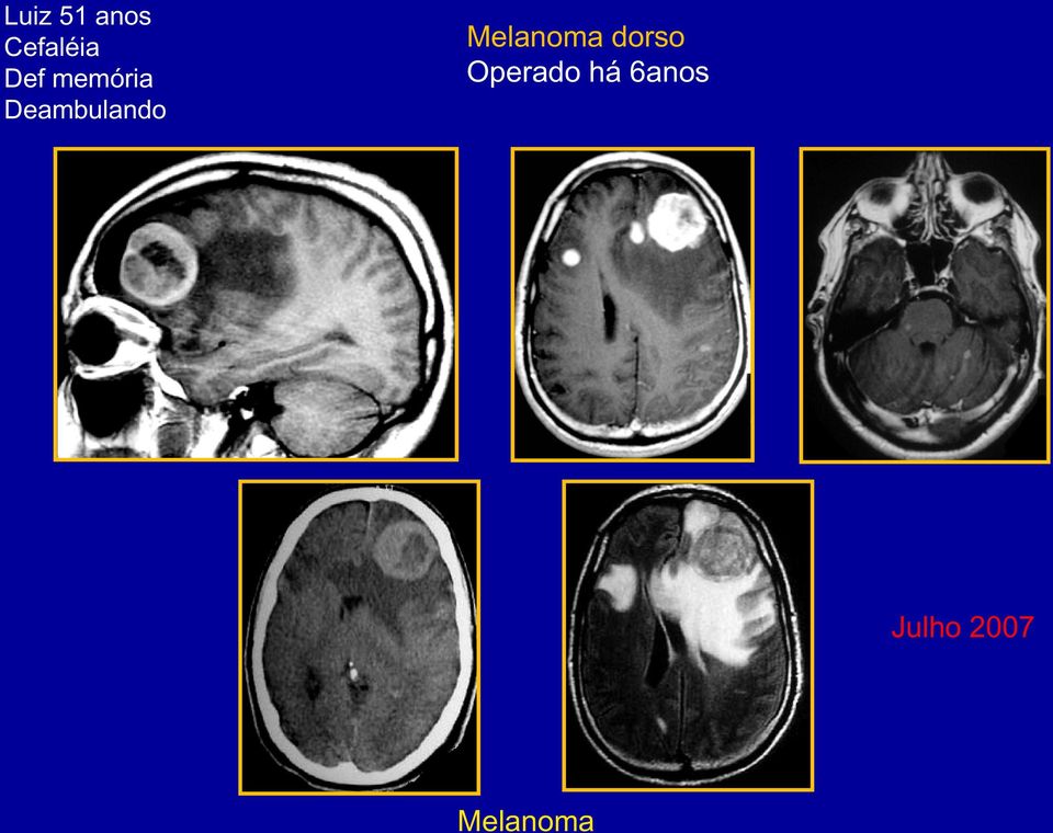 Melanoma dorso Operado