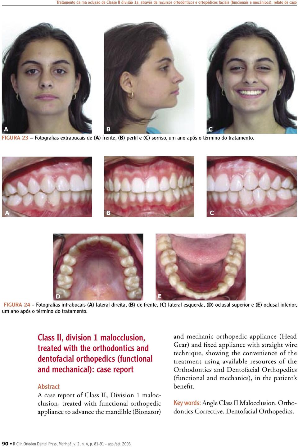 D FIGURA 24 - Fotografias intrabucais (A) lateral direita, (B) de frente, (C) lateral esquerda, (D) oclusal superior e (E) oclusal inferior, um ano após o término do tratamento.