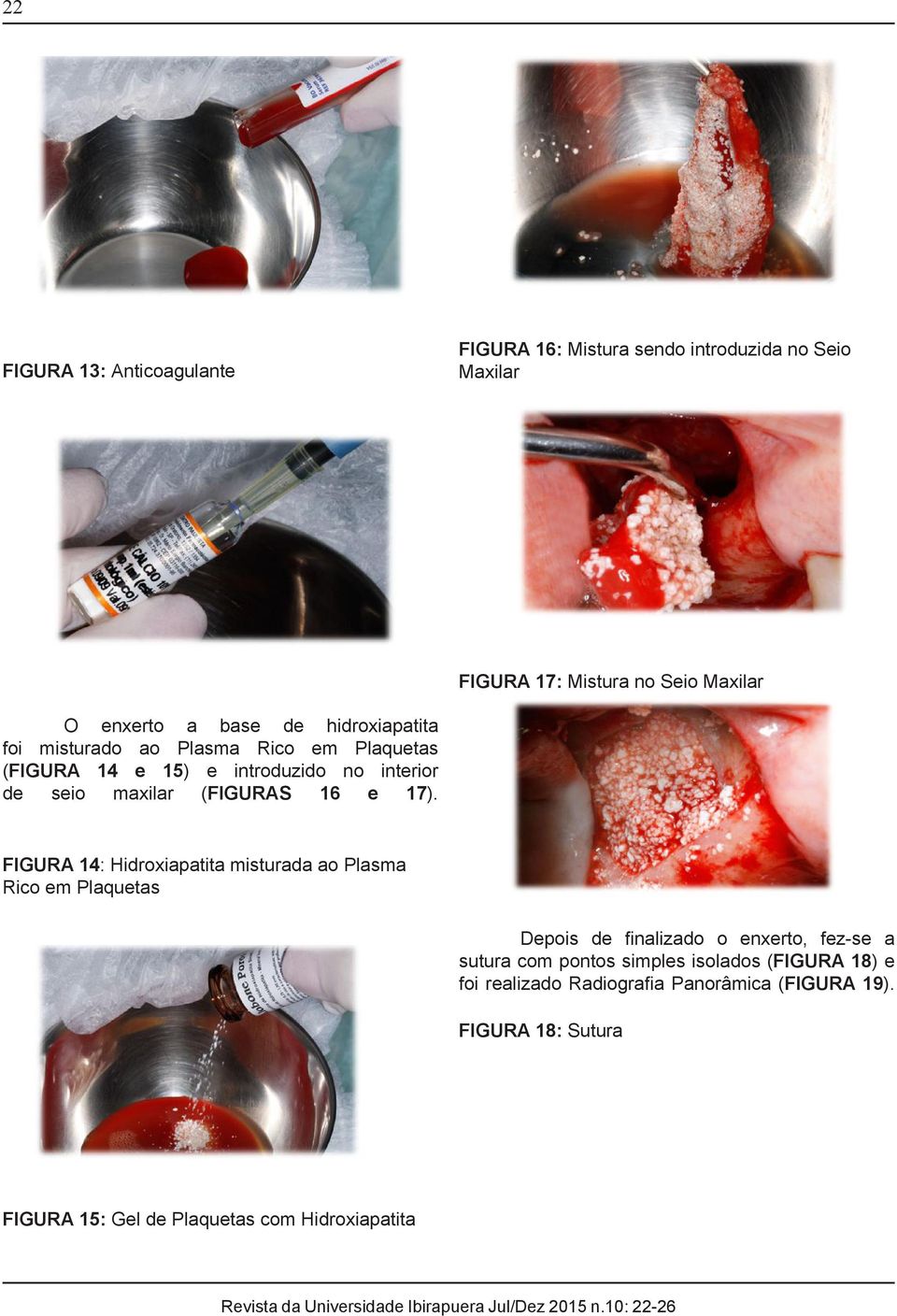 FIGURA 14: Hidroxiapatita misturada ao Plasma Rico em Plaquetas Depois de finalizado o enxerto, fez-se a sutura com pontos simples isolados (FIGURA