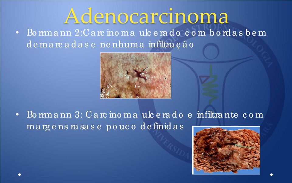 nenhuma infiltração Borrmann 3: Carcinoma