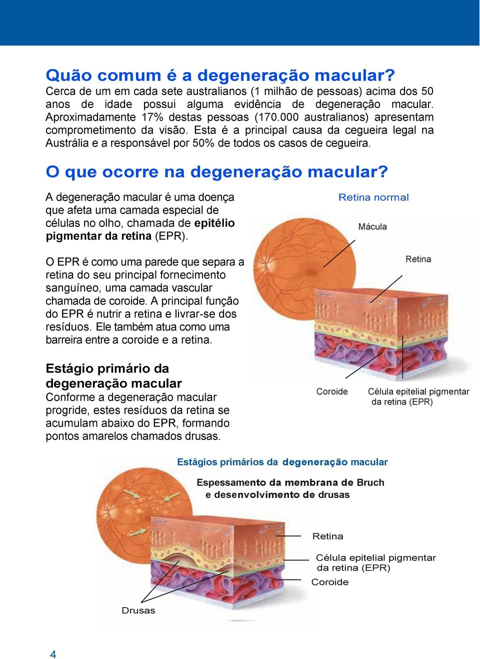 Esta é a principal causa da cegueira legal na Austrália e a responsável por 50% de todos os casos de cegueira. O que ocorre na degeneração macular?