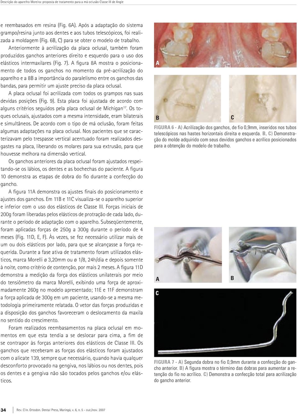 nteriormente à acrilização da placa oclusal, também foram produzidos ganchos anteriores direito e esquerdo para o uso dos elásticos intermaxilares (Fig. 7).