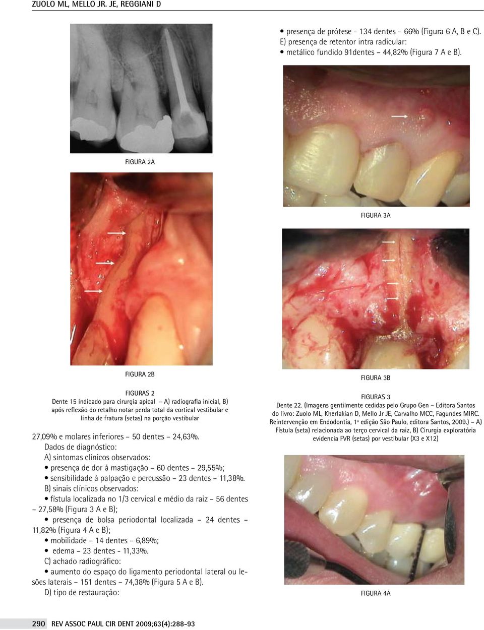 na porção vestibular 27,09% e molares inferiores 50 dentes 24,63%.