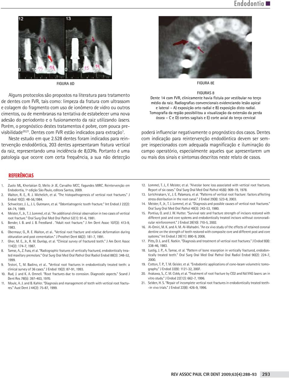 Porém, o prognóstico destes tratamentos é pobre, com pouca previsibilidade 20,21. Dentes com FVR estão indicados para extração 1. Neste estudo em que 2.