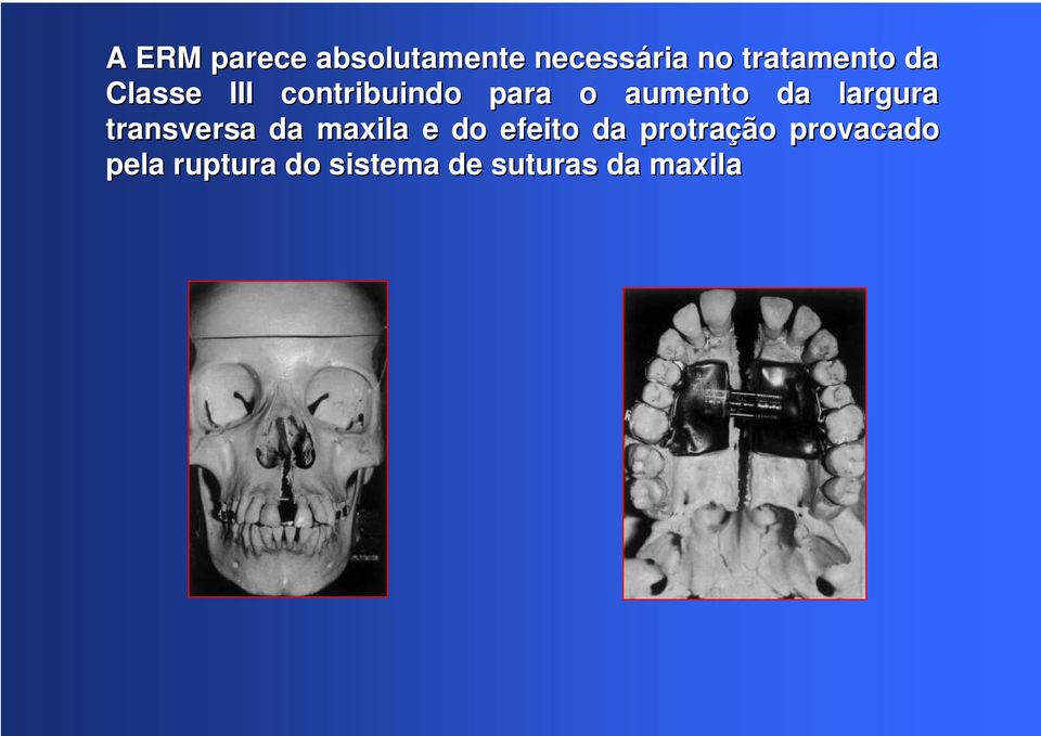 largura transversa da maxila e do efeito da