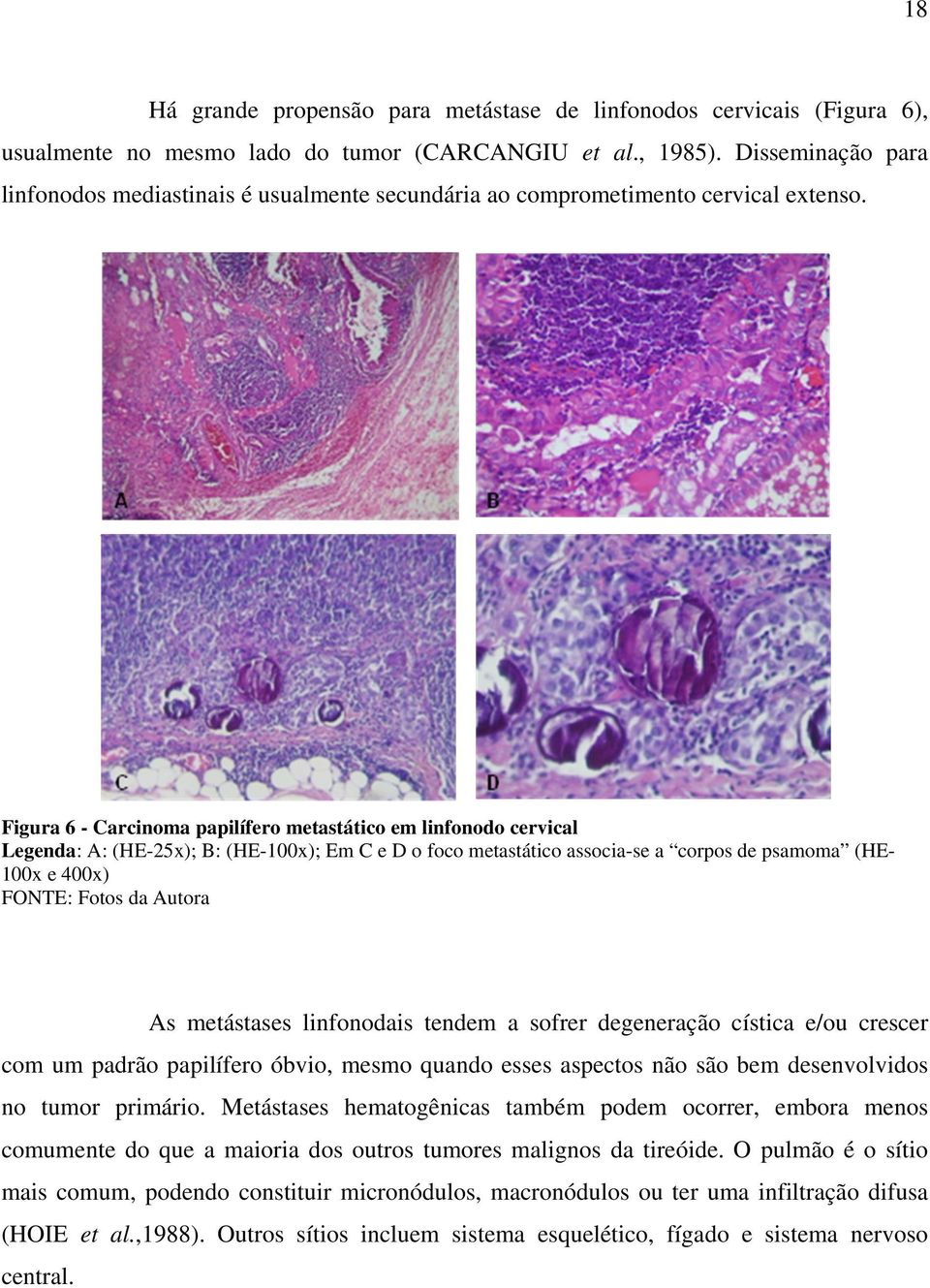 Figura 6 - Carcinoma papilífero metastático em linfonodo cervical Legenda: A: (HE-25x); B: (HE-100x); Em C e D o foco metastático associa-se a corpos de psamoma (HE100x e 400x) FONTE: Fotos da Autora