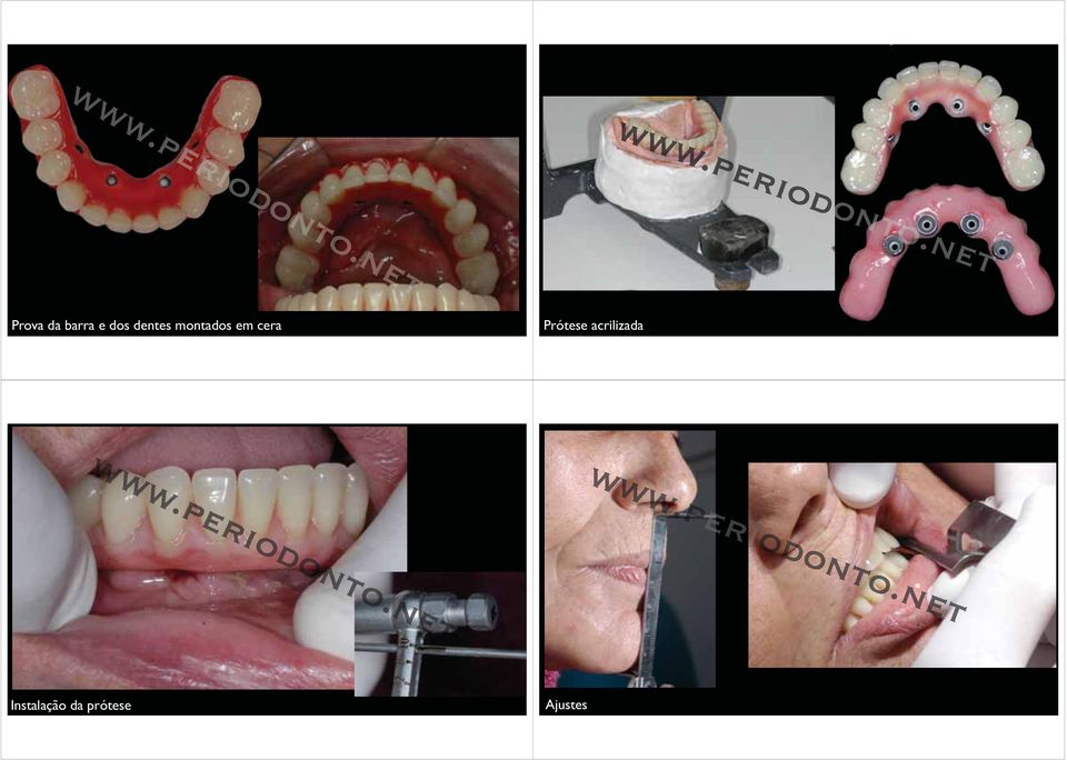 dentes montados em cera